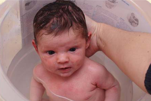 atopijski dermatitis