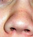 Alergijski nabor- rezultat dugotrajnog alergijskog pozdravljanja, trljanja nosa kod alergije - Littledot